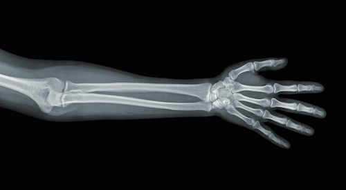 Arm x-ray