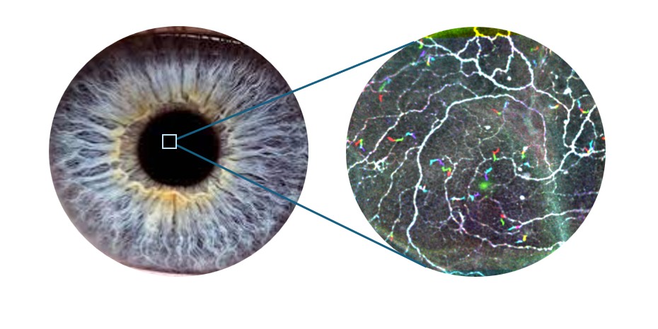 Left, a close-up of a human cornea and right, microscopic immune cells within the cornea. Credit: Fun-IVCM