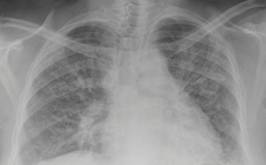 Digital chest radiograph of severe pulmonary fibrosis