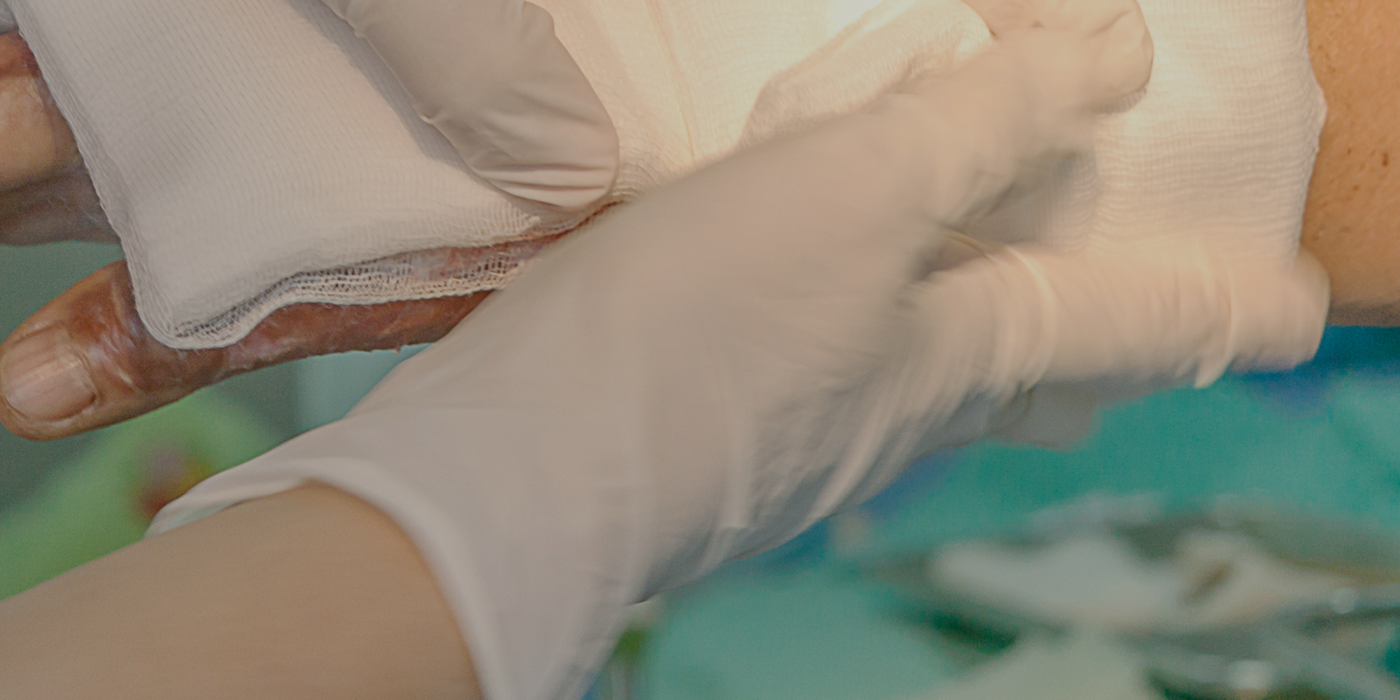 Burn injury being treated